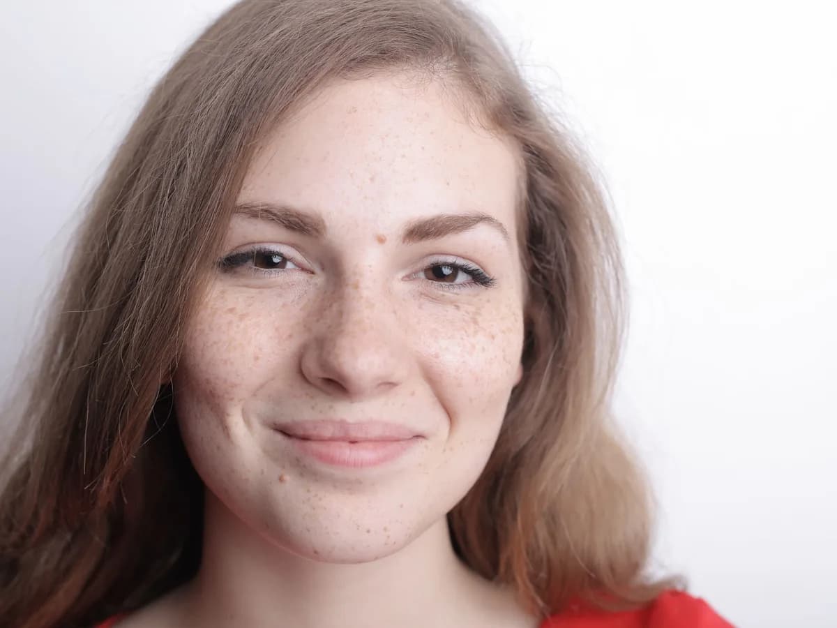 Smiling woman with freckles and uneven pigmentation across her cheeks