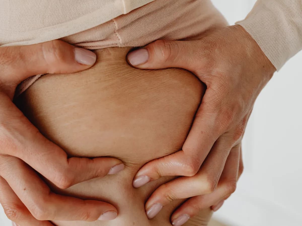 Hands holding the skin of an abdomen with stretch marks